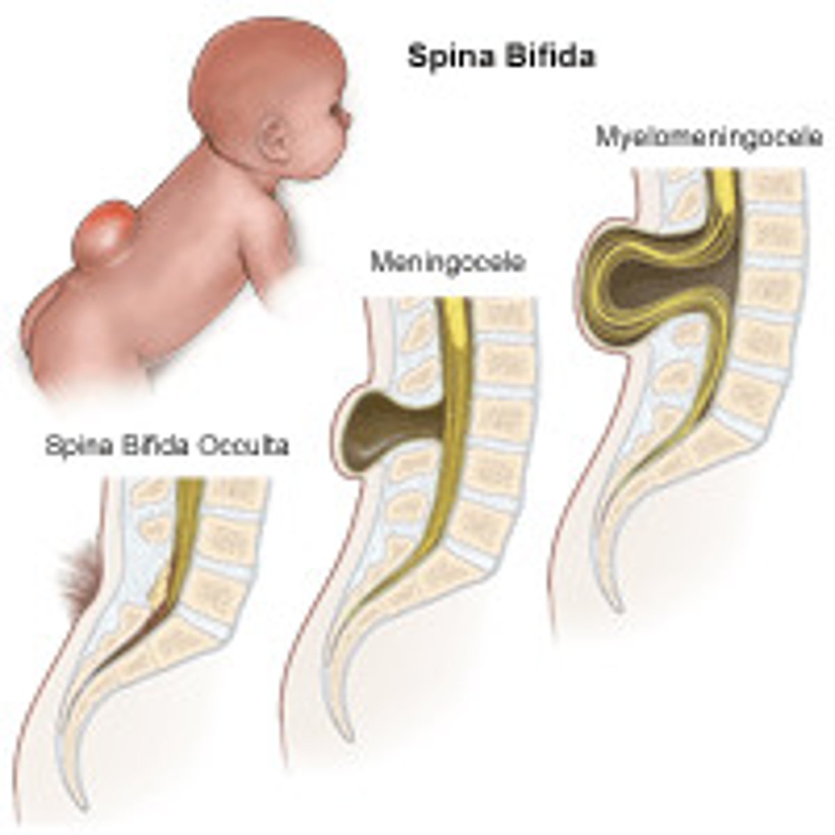 <p>A birth defect affecting the brain, spine, or spinal cord.</p>