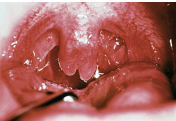 <ul><li><p>is the least complicated form of cleft palate</p></li><li><p>may still cause velopharyngeal insufficiency (VPI)</p></li></ul><p></p>