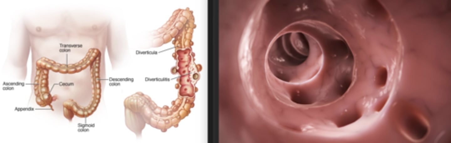 <p>the development of multiple colonic diverticula, predominately throughout the sigmoid colon, though the entire colon can be affected</p><p>• diverticula are small outpouchings</p>