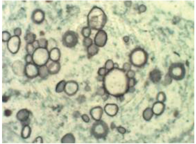 <p>A 42-year-old man originally from rural Brazil presents with chronic cough, weight loss, and painful ulcerative lesions on the oral mucosa. He reports heavy alcohol use and poor nutritional status. Chest imaging shows bilateral pulmonary infiltrates. Biopsy of an oral lesion reveals cells shown in the image. Which of the following organisms is the most likely cause of this patient’s condition?</p>