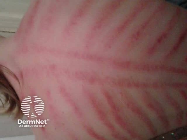 <p>A cultural practice where a coin in rubbed on the skin, leaving linear erythematous marks or petechia</p>