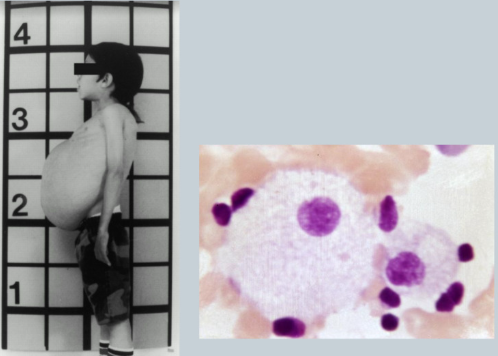 <p><span>Deficiency of beta-glucosidase =&gt; glycosphingolipids accumulate =&gt; enlarged liver/spleen (Gaucher cells appear in bone marrow)	</span></p><p><span>RETICULOENDOTHELIA SYSTEM (RES) DISEASE (phagocytes in immune system)&nbsp;&nbsp;</span></p>
