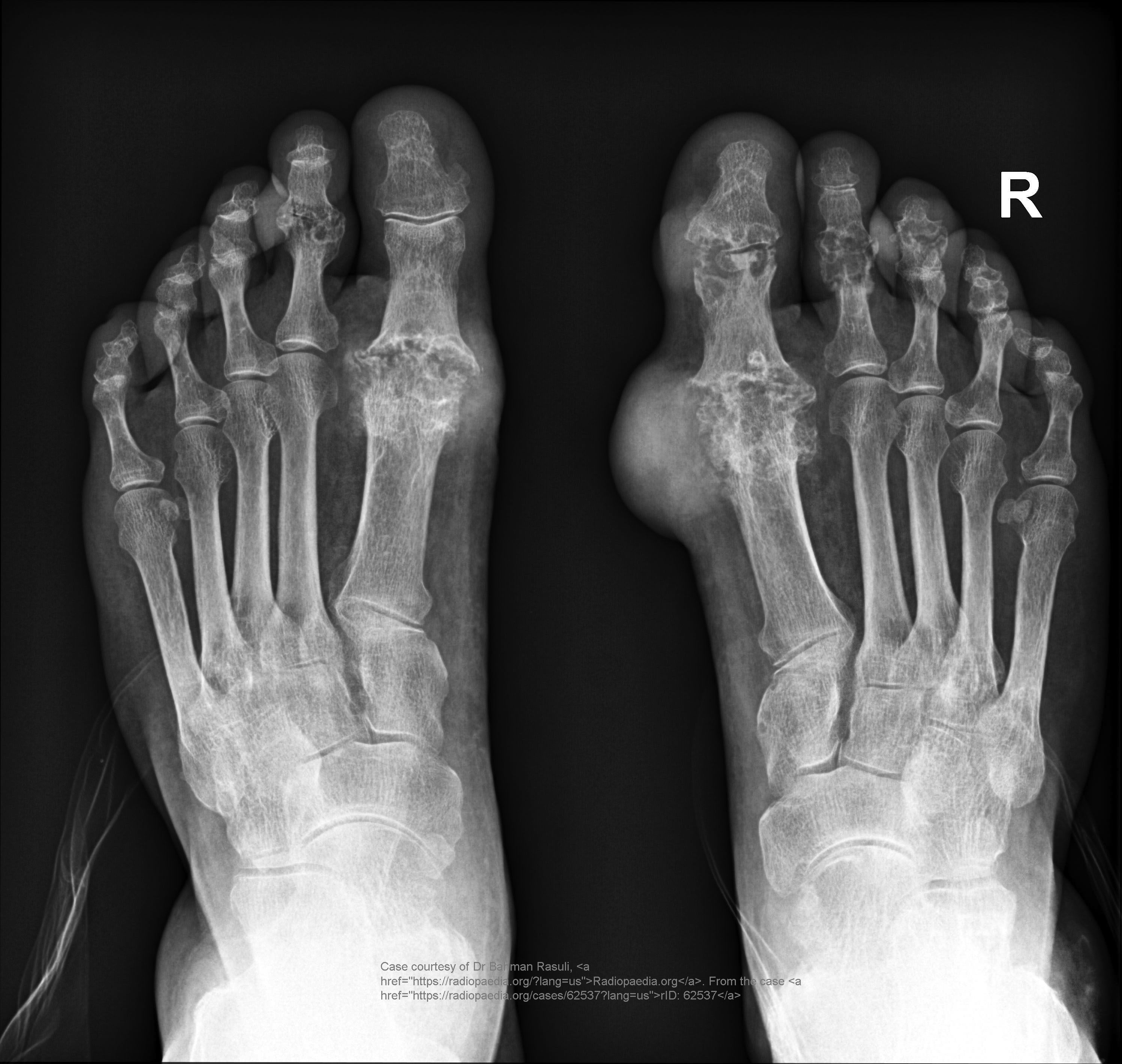 <p>Late changes: “mouse-bitten” erosions, overhanging edges, possible calcified tophi; no osteopenia.</p>