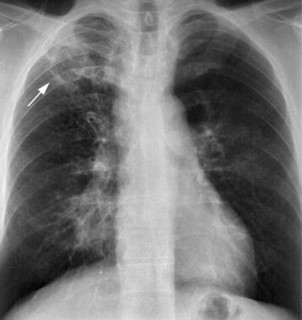 <p>Tuberculosis (type of ganulomatous disease)</p>