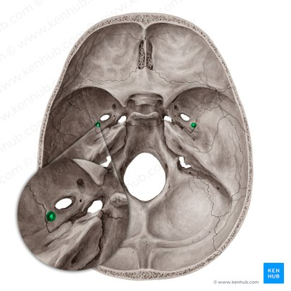 <p>small opening in sphenoid bone</p>