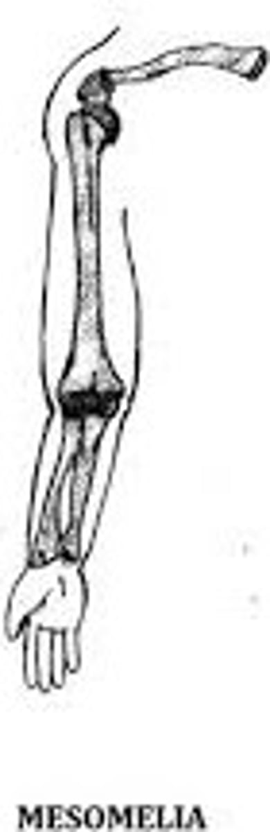 <p>Shortening of distal long bones like the tibia/fibula and radius/ulna.</p>