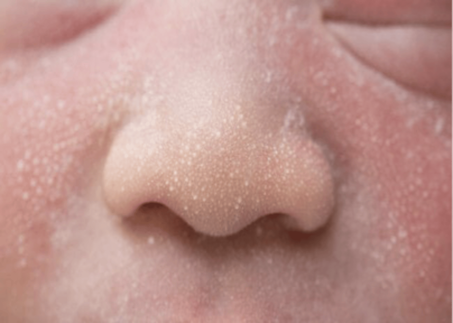 <p>An inflammatory reaction to yeast on the skin. Forms pustules that last 1-3 month</p>