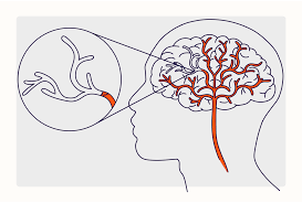 <p>Blood supply to brain is disturbed by blockage or uncontrolled bleeding </p>