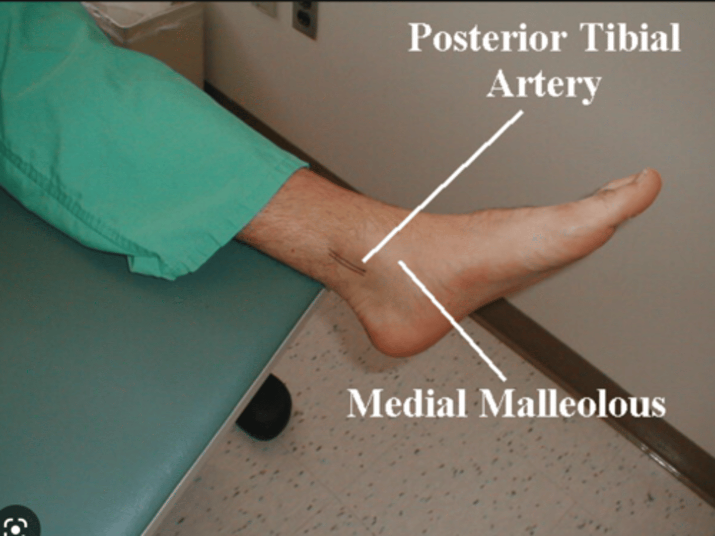 <p>commences at the lower border of the popliteus as one of the two terminal branches of the popliteal arteries, the other being the anterior tibial artery. It supplies the back of the leg, i.e. the two posterior compartments and the sole of the foot.</p>