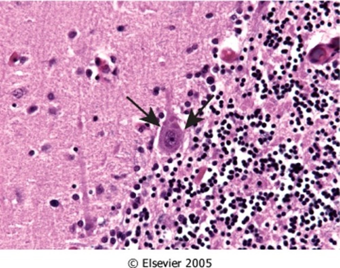 <p>Define Virus:</p><p>Viral Infection of meninges</p><p>Info:</p><p>-Ascends nerve from bite/contact to CNS</p><p>-Negri body (Cytoplasmic inclusions)</p><p>-Hyperexcitability (delusional)</p>