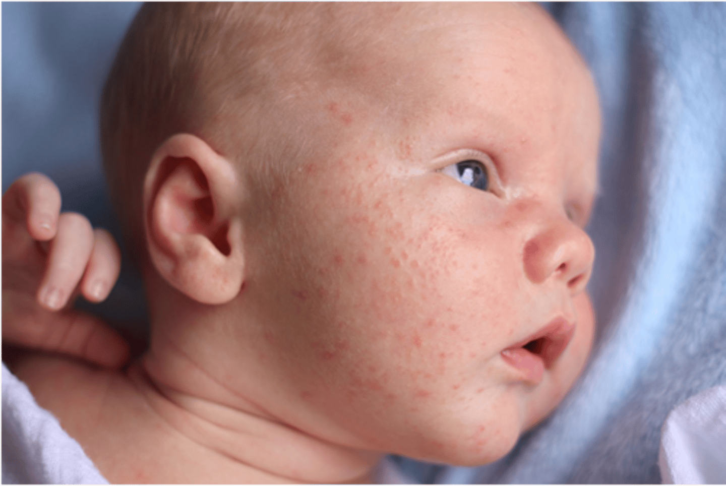 <p>red pustules and papules prominent over the cheeks and nose</p><p>due to maternal or infant androgens usually clears within 4 months</p>