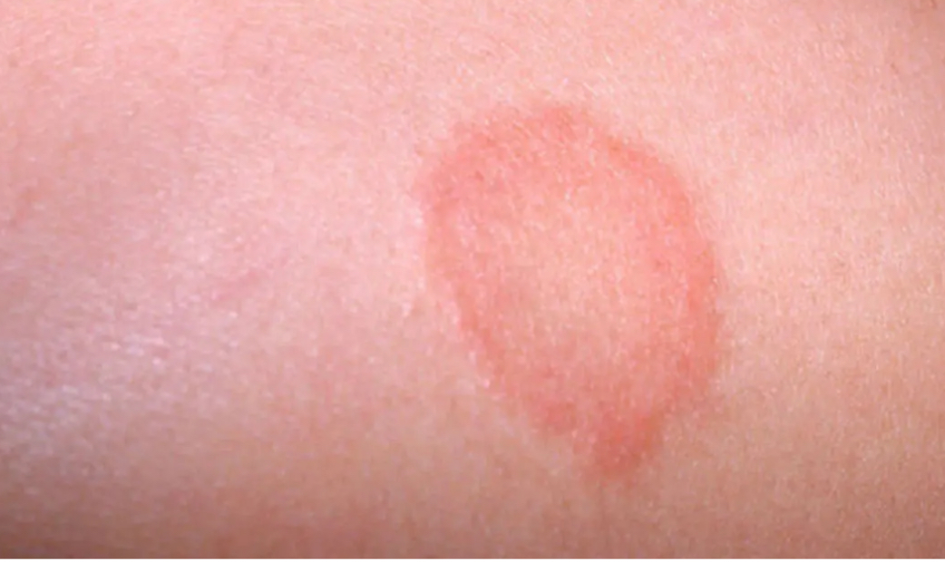 <p>Flat, circumscribed, discoloration that is GREATER than 1 cm </p>