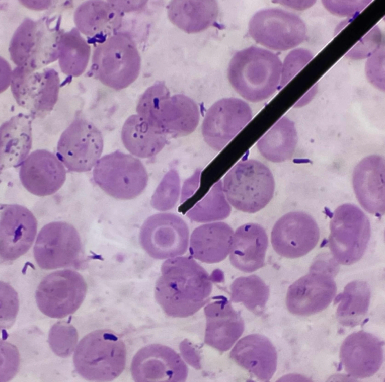 <p>A. Identify the pointed cell</p><p>B. Describe the striking feature</p><p>C. What is the characteristic finding?</p><p>D. What is the main defect of this cell? </p><p>E. Another term for this cell</p>