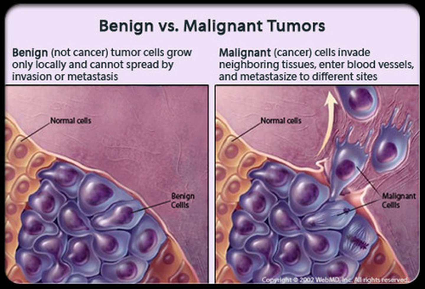 <p>A Benign Tumor is harmless whereas a Malignant Tumor is a tumor that is dangerous due to high speed growth, invasiveness, and nonfunctional daughter cells.</p>