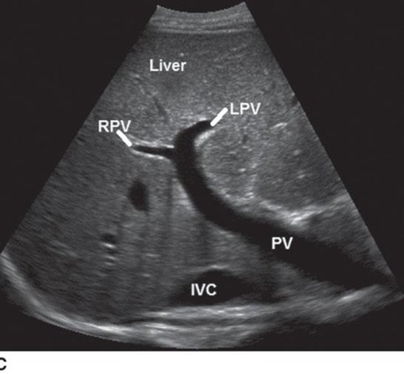<p>It is formed at the portal confluence where the splenic vein and superior mesenteric vein (SMV) join together.</p>