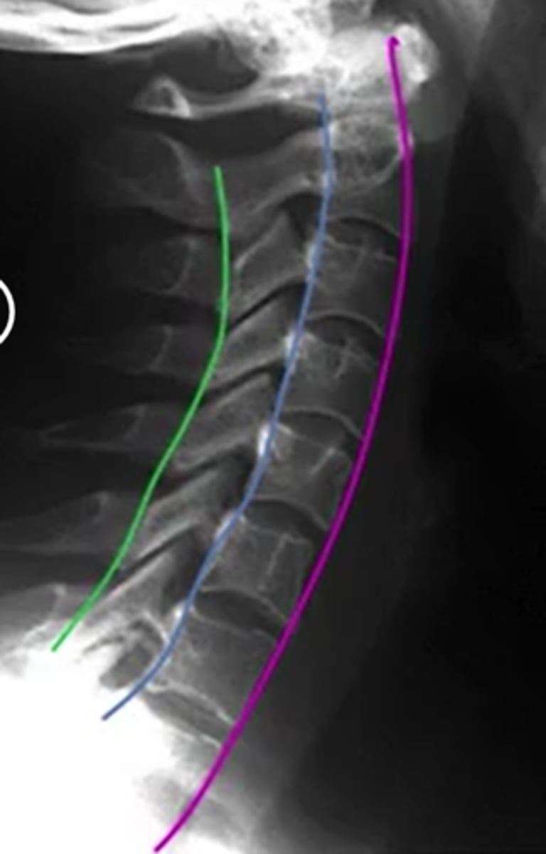 <p>purple anterior</p><p>posterior: blue</p><p>spinolaminar line: green</p><p>between blue and green is the spinal cord</p>