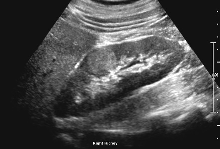 <p>Oncocytoma</p>