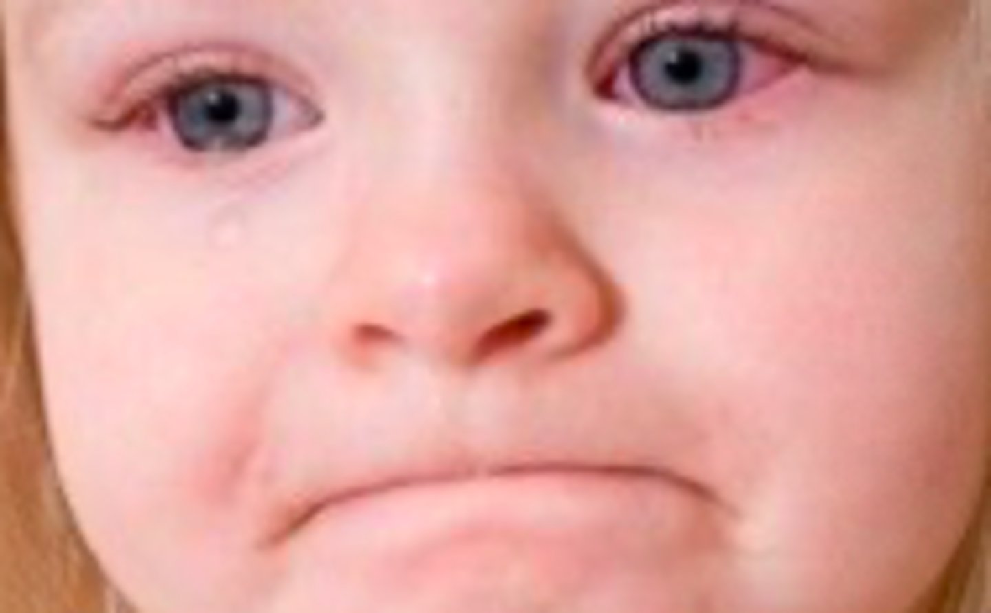 <p>Exanthems:</p><p>Subjective:</p><p>- Low grade fever</p><p>Acute onset of rash:</p><p>- Pruritic</p><p>- First appears on face then —&gt; trunk and extremities</p><p>- Spares palms and soles</p><p>- Lasts ~ 3 days</p><p>Eye redness</p>