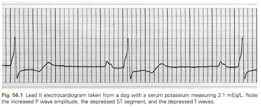 <ul><li><p><span>In the myocardial cell, a high intracellular/extracellular potassium concentration ratio induces a state of electrical hyperpolarization leading to prolongation of the action potential</span></p><ul><li><p><span>May predispose the patient to atrial and ventricular tachyarrhythimas, atrioventricular dissociation, and ventricular fibrillation</span></p></li></ul></li><li><p><span>ECG findings in hypokalemia are less reliable than hyperkalemia</span></p><ul><li><p><span>Include depression of the ST segment and prolongation of the QT interval</span></p></li><li><p><span>Increased P wave amplitude, prolongation of the PR interval, and widening of the QRS complex may also occur</span></p></li></ul></li><li><p><span>Hypokalemia predisposes to digitalis-induced cardiac arrhythmias and causes the myocardium to become refractory to the effects of class I antiarrhythmic agents</span></p></li></ul><p></p>