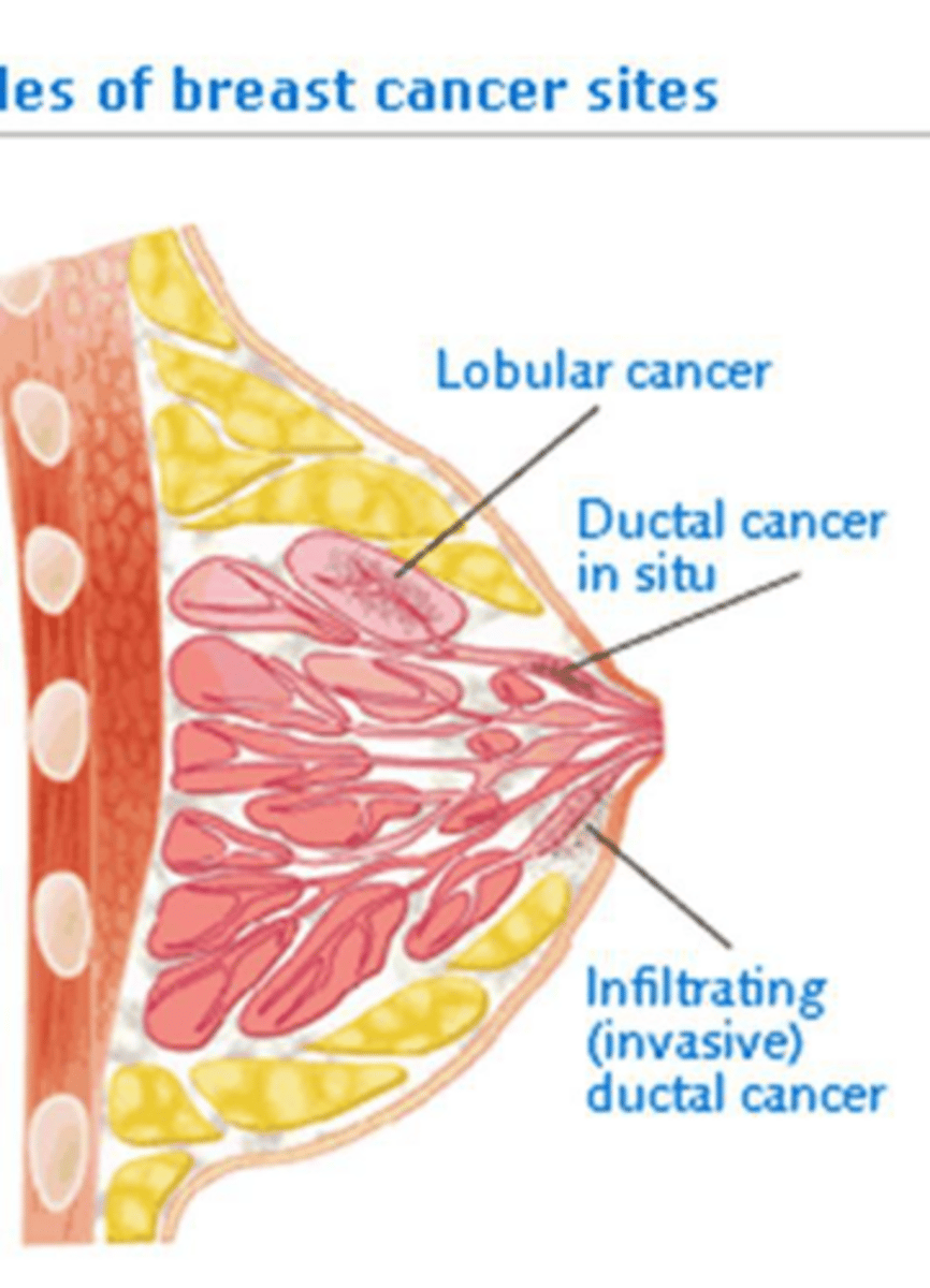 <p>Ductal carcinoma, lobular carcinoma, and nipple (Paget disease).</p>