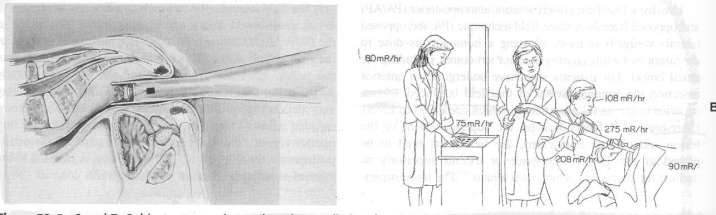 <p>To possibly offer a<strong> sphincter-preserving</strong> technique for patients with<strong> distal rectal cancers confined to the bowel wall&nbsp;</strong></p>