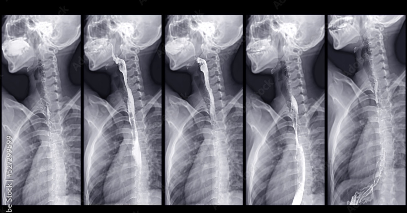 <p>esophagus</p>