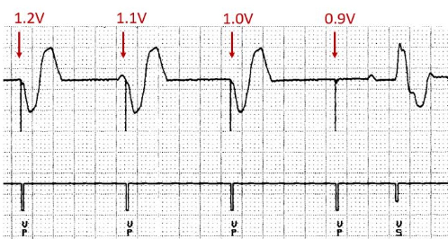 <p>In this example, the pulse width is held constant at 0.4ms while the voltage is decremented until loss of capture is seen. Loss of capture occurs at 0.9V so the ventricular stimulation threshold is 1.0V @ 0.4ms</p>