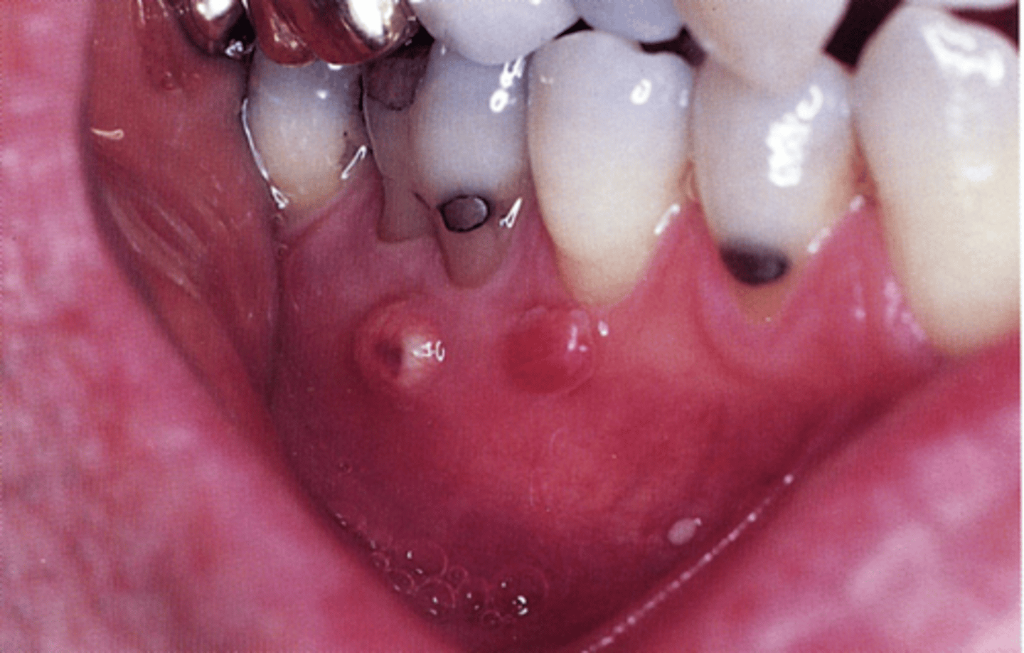 <p>parulis/sinus track</p>