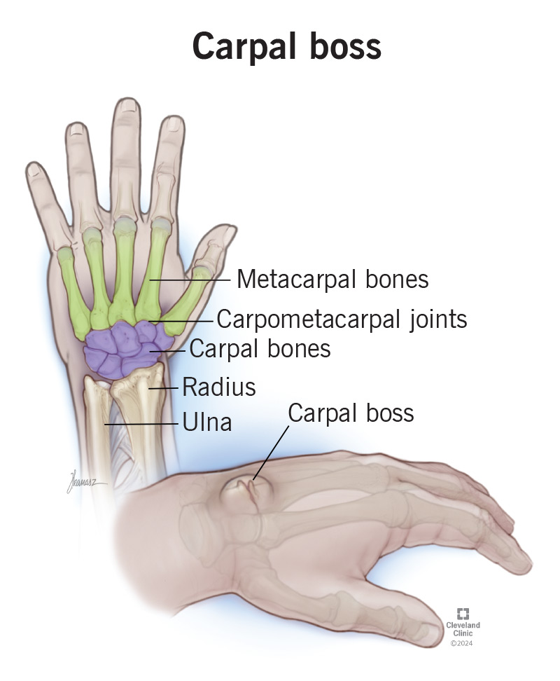 <p>Carpal </p>