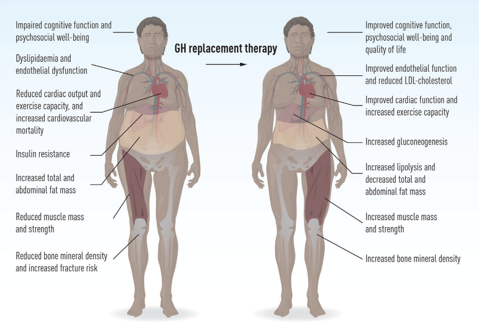 <p>pituitary gland doesn’t produce enough growth hormone → inhibiting growth in all cells of the body.</p>