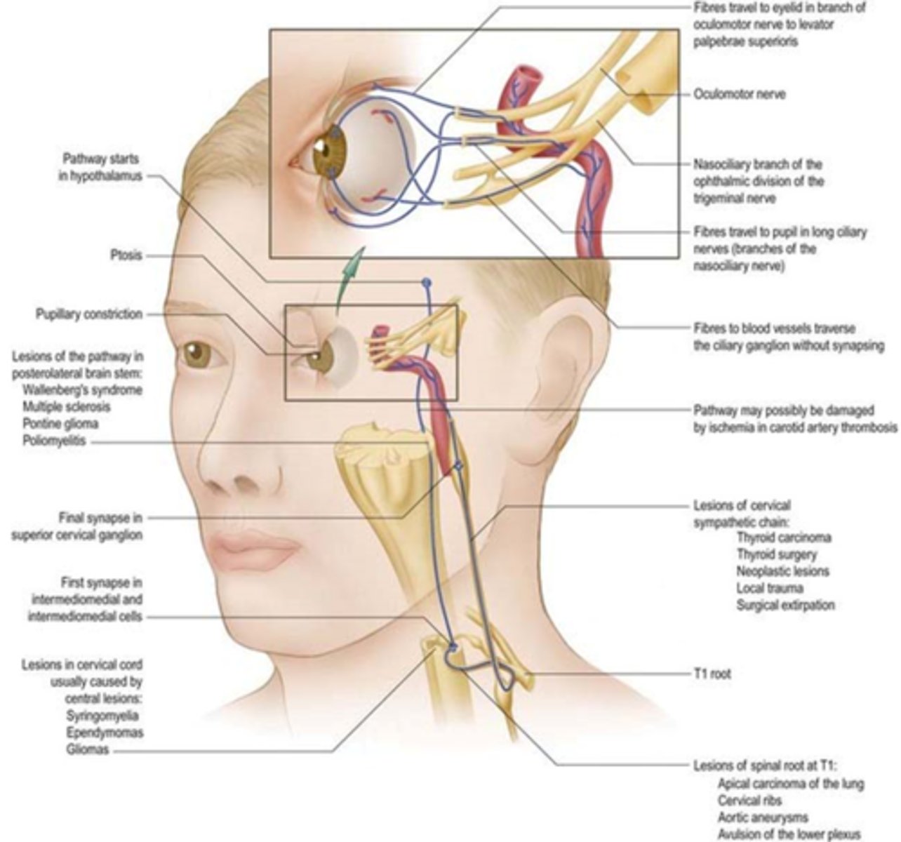 <p>1st axon starts in hypothalamous (midbrain) = 1st synapse in ciliospinal center of budge at C8 = axon extends over apex of lung = 2nd synapse in sup cervical ganglion = 3rd synapse in iris dilator mm</p>