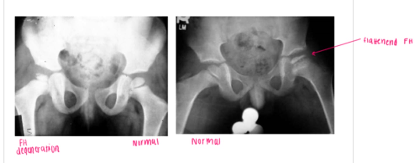 <p>a type of osteochondrosis or disease of the growth centers in children which begins as a degeneration followed by regeneration and recalcification</p><p>*unknown etiology</p><p>**more likely in males, onset is generally 5-7 yrs of age (3-13)</p><p>FUNCTIONAL DEFICITS--&gt; pain, limited ROM, gait changes</p><p>COMPENSATORY MOVEMENTS--&gt; limit motion/use of the joint, limit overall activity level</p><p>COURSE--&gt; bone necrosis, revascularization, reossification over a period of 24-36 months</p>