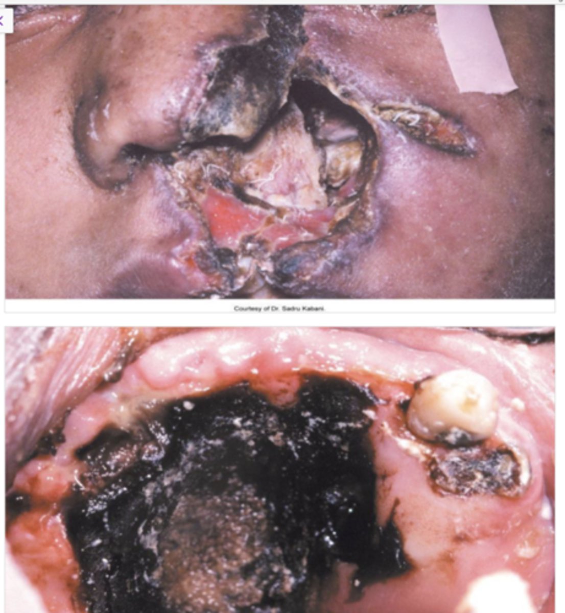 <p>AKA phycomycosis</p><p>• Fungal infection - destroys sinus, nose, and palate</p><p>• associated with DM or immunocompromised pt </p>
