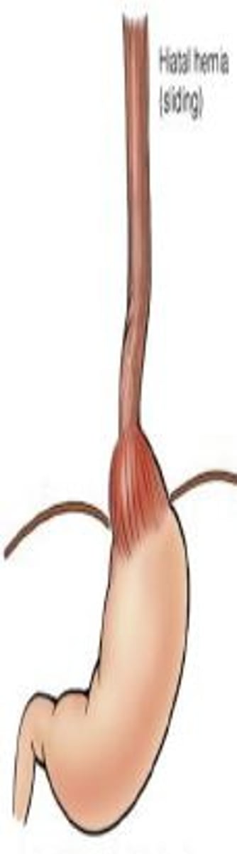 <p>-In a patient with severe reflux disease consider hiatus hernia<br>-Incompetence of the <strong>lower esophageal sphincter LES</strong><br>-Symptoms are accentuated by positions favoring reflux (bending forward, lying supine) and obesity.</p>