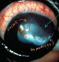 <ul><li><p><strong><u>Non-cellular corneal infiltrates</u></strong></p><ul><li><p>Crystalline materials: cholesterol or mineral </p></li></ul></li><li><p><span style="background-color: transparent;"><strong><u><span>Dystrophy</span></u></strong></span></p><ul><li><p><span style="background-color: transparent;"><strong><span>Cs:</span></strong><span> </span></span><span style="background-color: transparent; color: red;"><u><span>Non-painful, Non-vascularized, Bilateral</span></u><span>,</span></span><span style="background-color: transparent;"><span> Loss of Corneal Transparency</span></span></p></li><li><p><span style="background-color: transparent;"><strong><span>Tx:</span></strong><span> </span></span><span style="background-color: transparent; color: red;"><span>No treatment</span></span><span style="background-color: transparent;"><span> needed, steroids make it worse </span></span></p></li></ul></li></ul><ul><li><p><span style="background-color: transparent;"><strong><u><span>Degeneration</span></u></strong></span></p><ul><li><p><span style="background-color: transparent;"><strong><span>Et:</span></strong></span><span style="background-color: transparent; color: red;"><strong><u><span> Secondary</span></u></strong></span><span style="background-color: transparent;"><span> to inflam, cushings, hypothyroid, hypercalcemia, DM, steroid use</span></span></p></li><li><p><span style="background-color: transparent;"><strong><span>Cs:</span></strong><span> Loss of Corneal Transparency, deposits/crystals in eye </span></span></p></li></ul></li></ul><p></p>