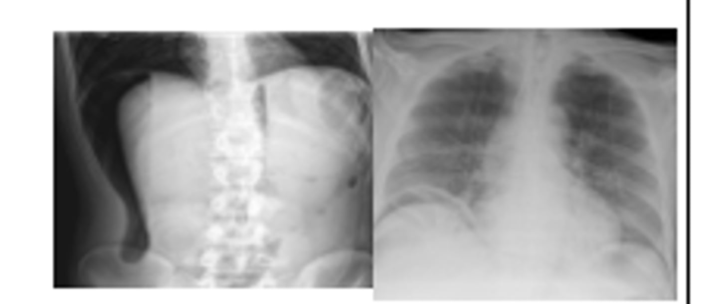 <p>False (20% reveal no free air)</p>