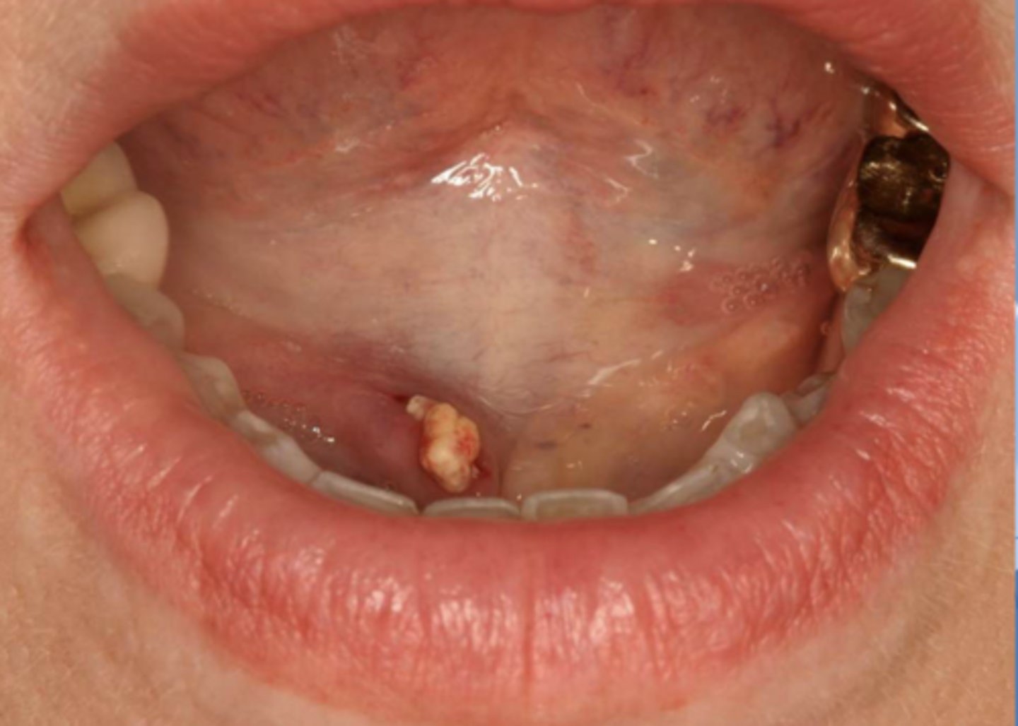 <p>ID the pathology during surgery:</p>