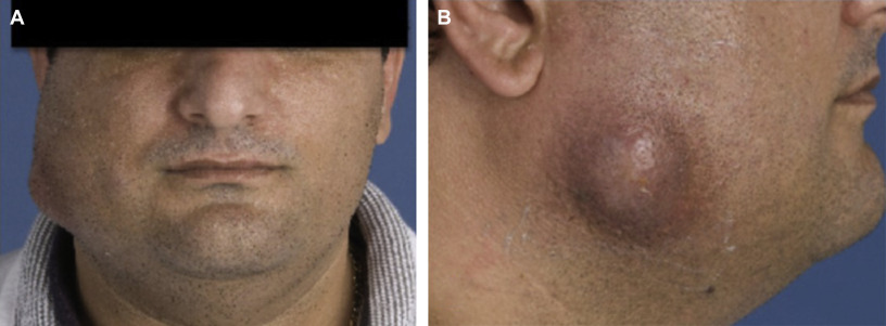 <p>b) Cervicofacial abscess (lumpy jaw)</p>