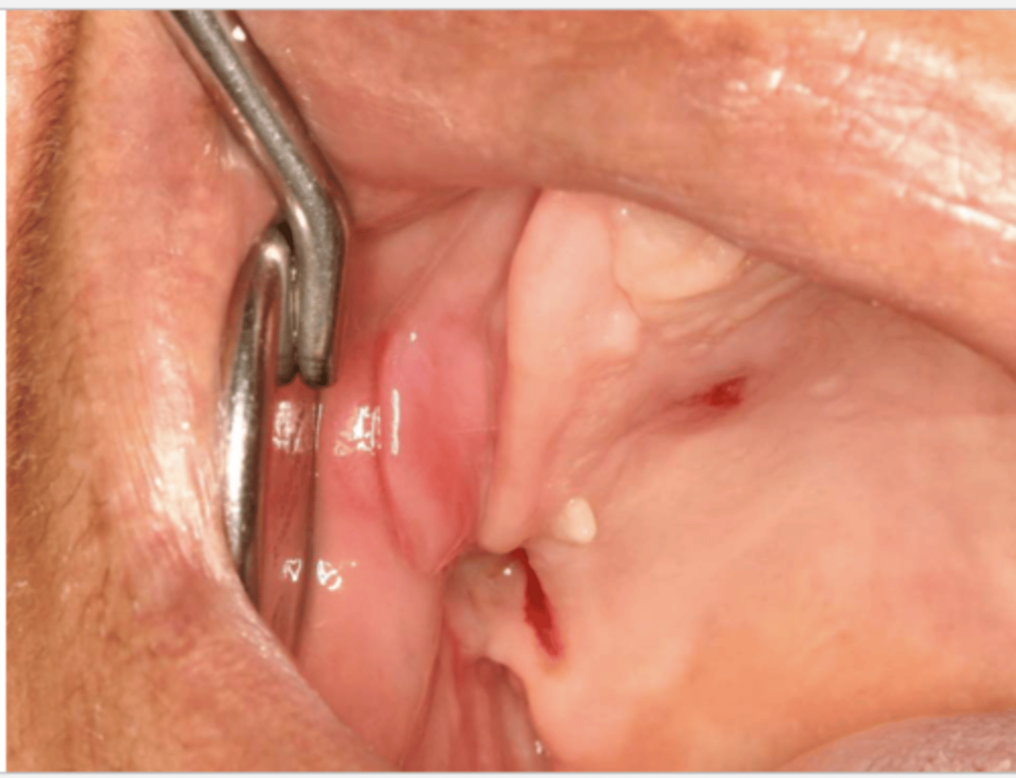 <p>What do the following clinical features describe?</p><p>-single or multiple folds of hyperplastic tissue in alveolar vestibule</p><p>-fibroepithelial poly/leaf-like denture fibroma may be seen along palatal mucosa</p>