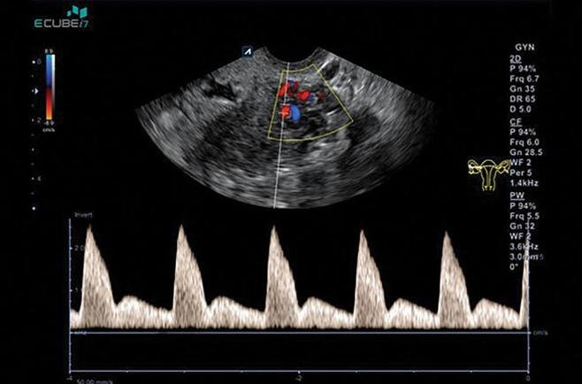 <p>What may help distinguish between benign and malignant endometrial thickening?</p>