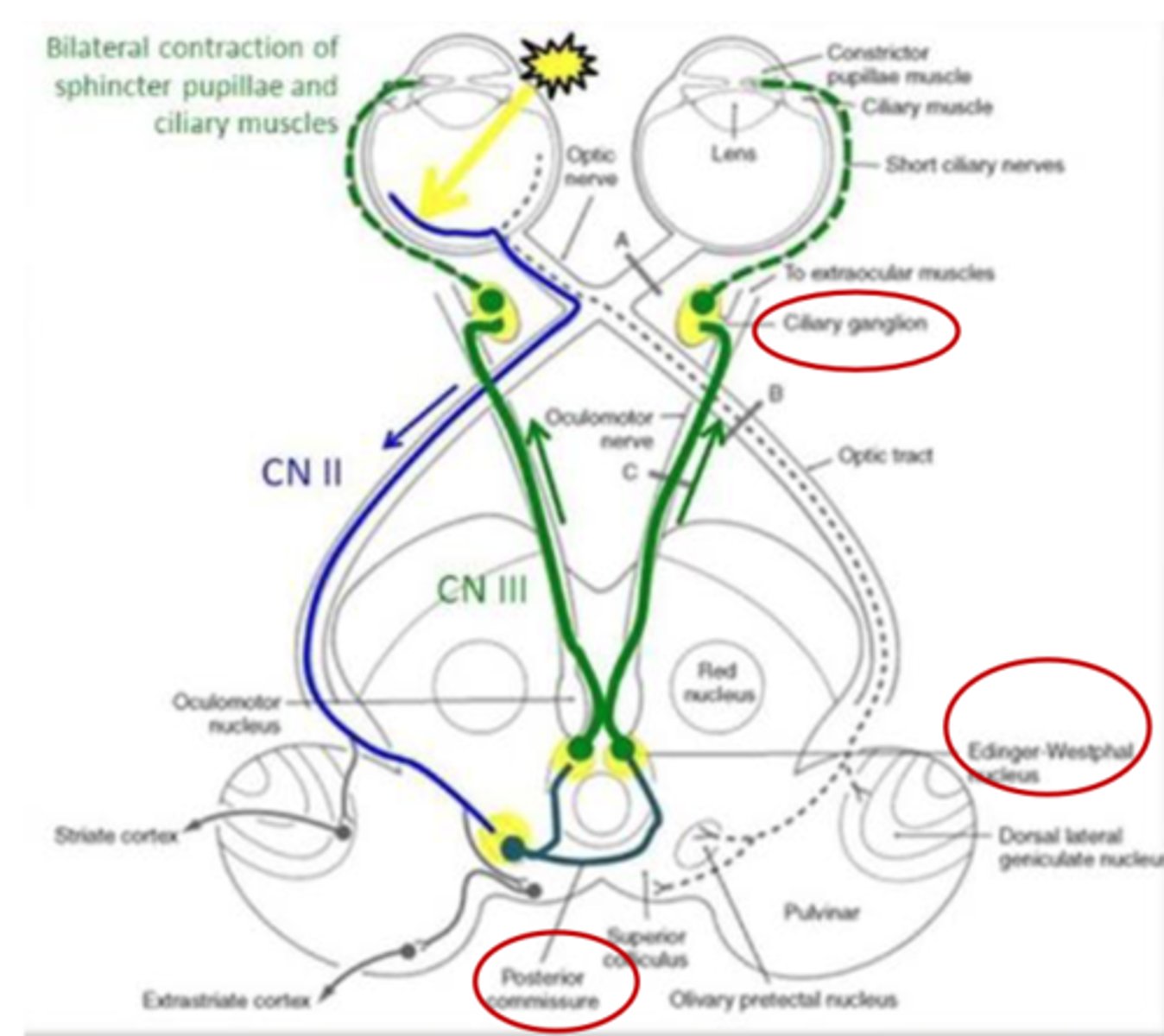 <p>- Pupillary light reflex dysfunction</p><p>- Reflex in left eye</p><p>- No reflex in right eye</p>