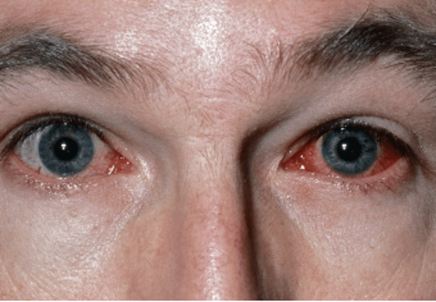 <p><u>Etio</u>: <strong>Chlamydia trachomatis</strong>, highly contagious, <strong>gradual onset 1-4 weeks</strong>, overcrowded public area, partner with STI</p><p><u>S&amp;S</u>: <strong>Redness clear to mucopurulent discharge</strong>, FB sensation, light sensitivity, no blurring of vision, possible mild discomfort, erythema, <strong>commonly pt has re-infections</strong></p><p><u>Complications</u>: epithelial keratitis, corneal neovascularization, palpebral conjunctivitis, corneal scarring, blindness</p><p><u>Testing:</u> <strong>swab of discharge (culture)</strong> + report to PH, offer STI/preg test</p><p><u>Tx:</u> <strong><u>NDKA</u></strong>: <strong>Azithromycin</strong> 1gm PA now AND <strong>Bacitracin</strong> opthalmic ointment, referral - ophthalmologist - urgent, wash eye w/ cloth</p>