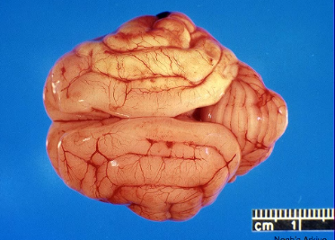 <p>what type of hemorrhage is this?</p>