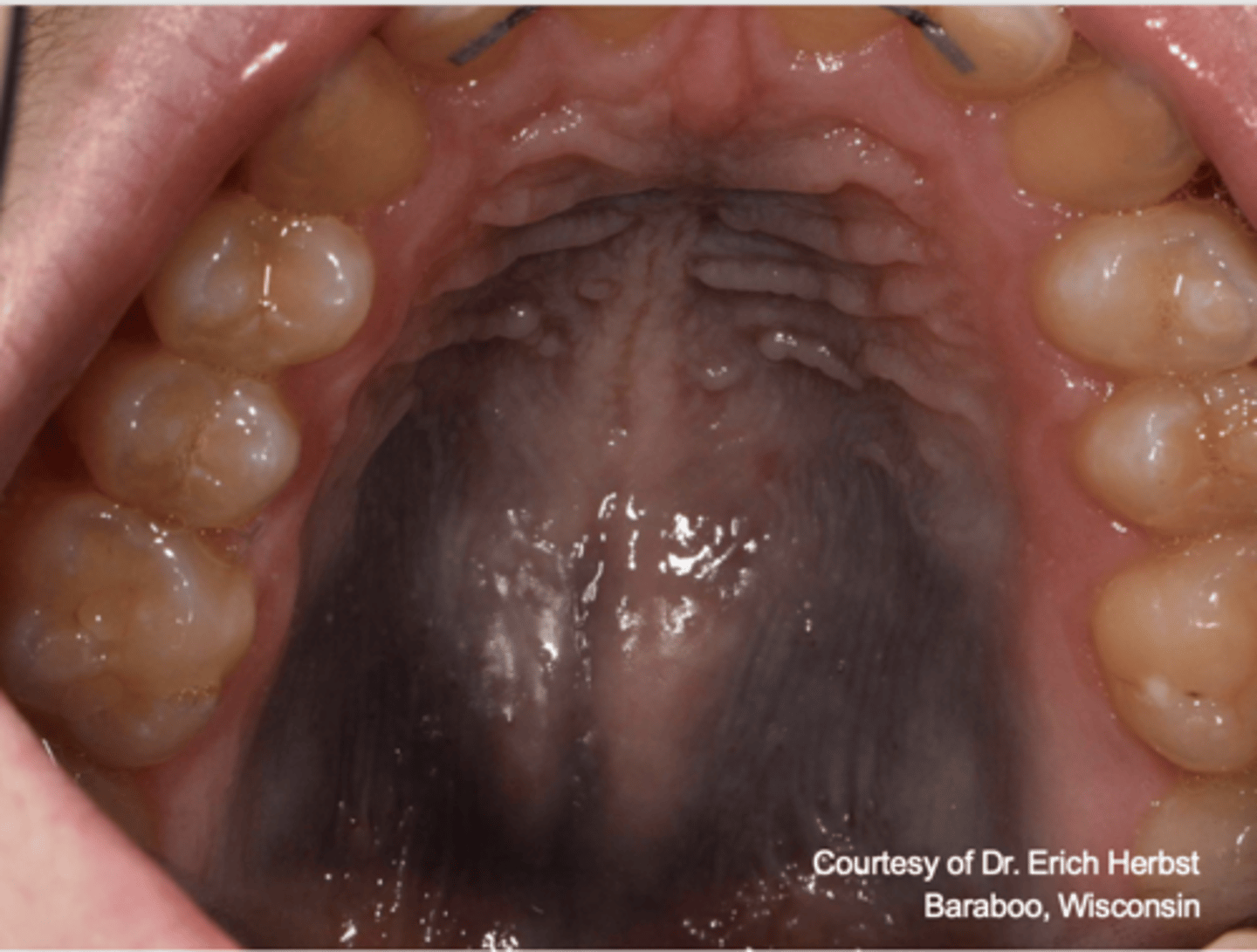 <p>What type of pigmented lesion?</p>