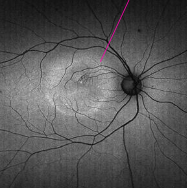 <p>central serous choriotetinopathy</p>