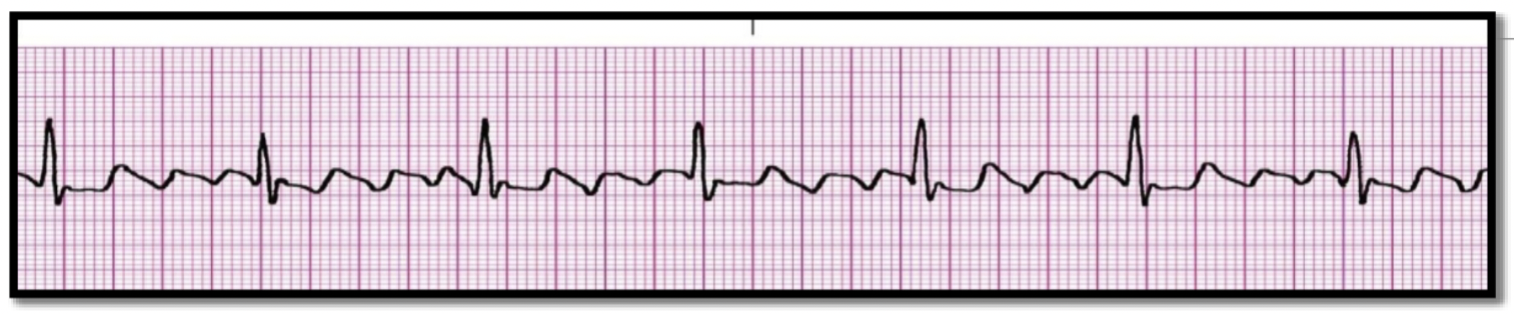 <p>What is the rhythm?</p>
