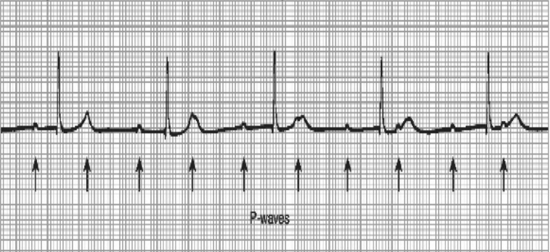 <p>Third Degree Heart Block</p>