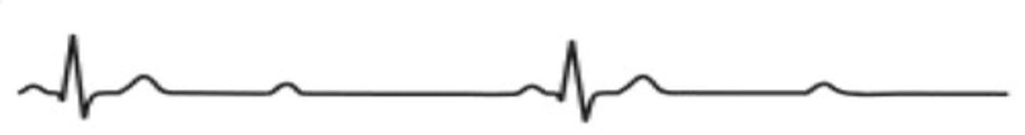 <p>Which type of arrhythmia is this?</p>