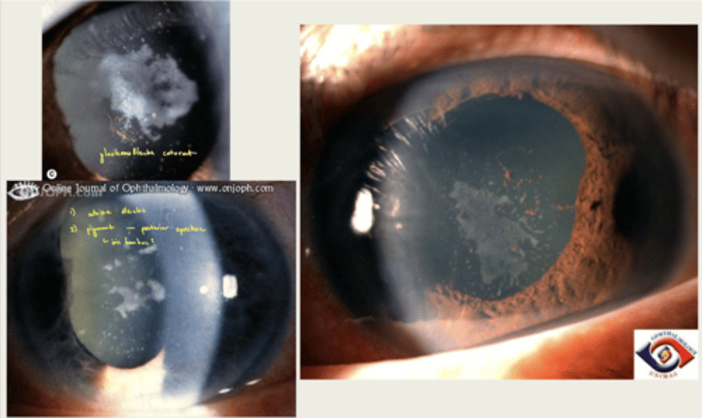 <p>1. grey-white subcapsular/capsular opacities within pupil area</p><p>2. may have pigment on lens as well</p>