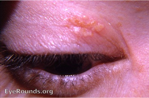 <p>> swollen lids + conjunctivitis&nbsp;</p>